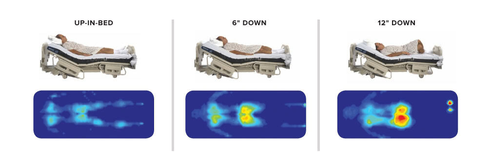 Pressure Ulcer | Hercules Patient Repositioner | Morel Company